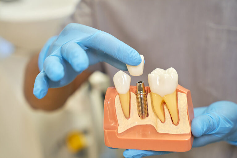 implanty zębów lublin